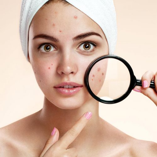 علت جوش های صورت و سریعترین درمان به روش خانگی 