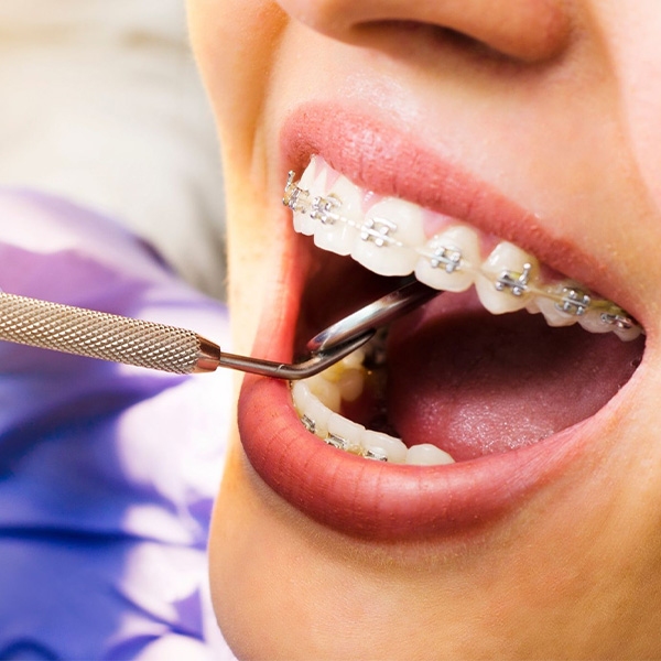 دندان عقل و تأثیر آن بر روند ارتودنسی