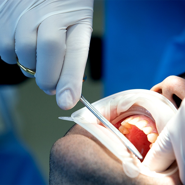 روش های جراحی دندان عقل