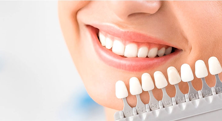 تفاوت بین لمینت و کامپوزیت دندان چیست؟ کدام یک بهتر است؟