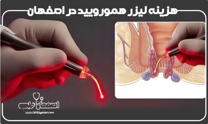 جدیدترین درمان هموروئید؛ لیزر بواسیر در اصفهان بدون درد و خونریزی