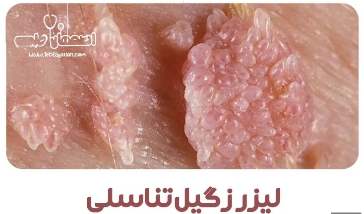 لیزر زگیل تناسلی در اصفهان؛ درمان قطعی و بدون بازگشت